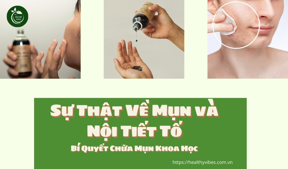 Sự Thật Về Mụn và Nội Tiết Tố chữa mụn khoa học